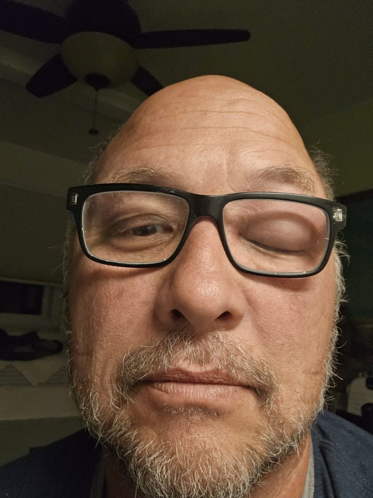 Swollen Forehead Sting